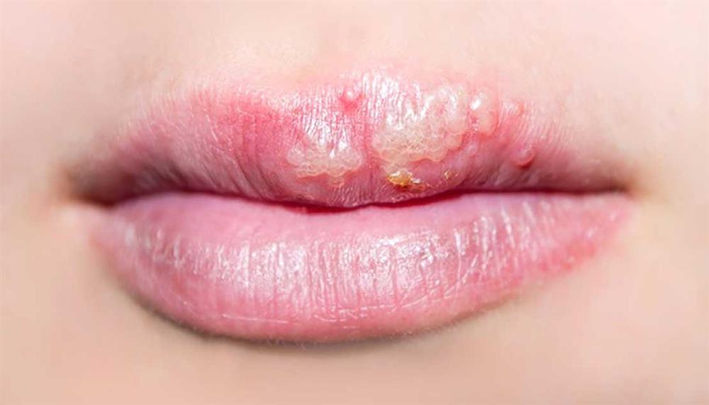 herpes